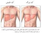 درمان گیاهی کبدچرب.سیروزکبدی موثروقطعی