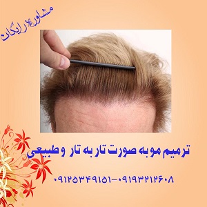 کاشت وترمیم موی موتاب (موهای طبیعی)