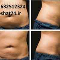 لاغری موضعی و درمان سلولیت 