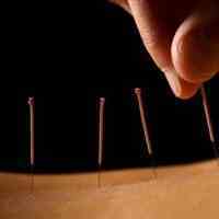 طب سوزنی | کاشت نخ