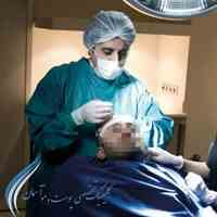 کاشت مو- پیوند مو-کاشت موی طبیعی