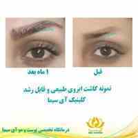 کاشت تخصصی مو ، ابرو و ریش 