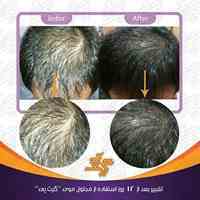 محلول ضد ریزش و رویش مجدد مو (گیت پی)