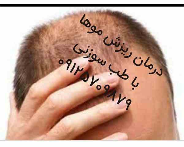 درمان ریزش مو با طب سوزنی