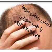 درمان ریزش مو با طب سوزنی