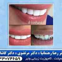 بهترین متخصص ایمپلنت در شرق تهران