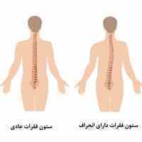 انحراف ستون فقرات