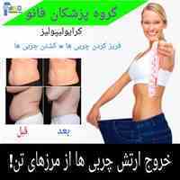 لاغری با کرایولیپولیز