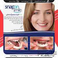 لمینت متحرک دندان - Snap On Smile