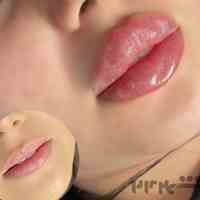 تخفیف مزوتراپى،میکرو، تزریق ژل و بوتاکس