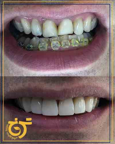 ارتودنسی دندان در تهران _ تهرانپارس | کلینیک دندانپزشکی ترنج 