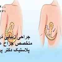 جراحی شکم بیتا کلینیک تهران-جراحی شکم-درمان افتادگی شکم با لیزر-کوچک کردن شکم