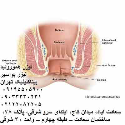 لیزر بواسیر-لیزر هموروئید-درمان لیزر تهران-درمان هموروئید