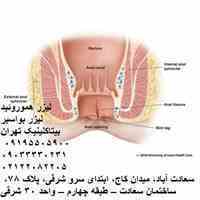 لیزر بواسیر-لیزر هموروئید-درمان لیزر تهران-درمان هموروئید