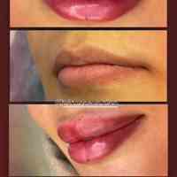 تزریق ژل لب