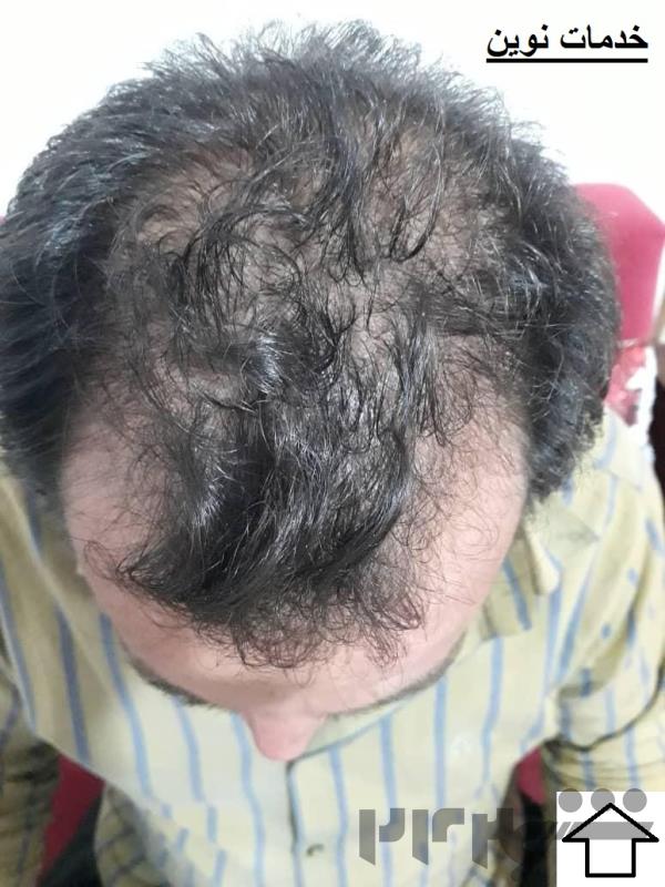 کاشت موی سر و ابرو تخصصی در اردبیل