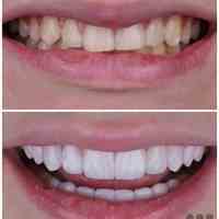 دندانپزشکی ایمپلنت ونیر کامپوزیت لمینت