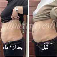 لاغری در صادقیه