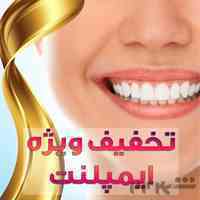 کاشت ایمپلنت فقط 10 میلیون همراه با پزشک متخصص
