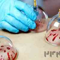 آموزش حجامت و زالو 