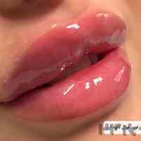 کلینیک زیبایی آمیتیس یزد ارائه انواع خدمات تزریق ژل، بوتاکس، مزوتراپی و ...