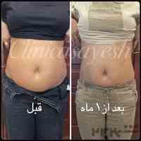 لاغری با دستگاه کرایولیپولیز