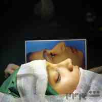 عمل جراحی زیبایی بینی