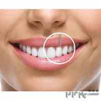 ایمپلنت دندان مشهد