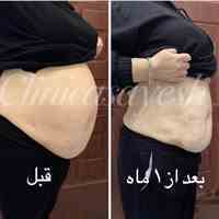 لاغری در صادقیه