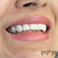 ایا لمینت دندان را خراب میکند؟