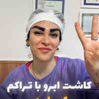 کاشت ابرو