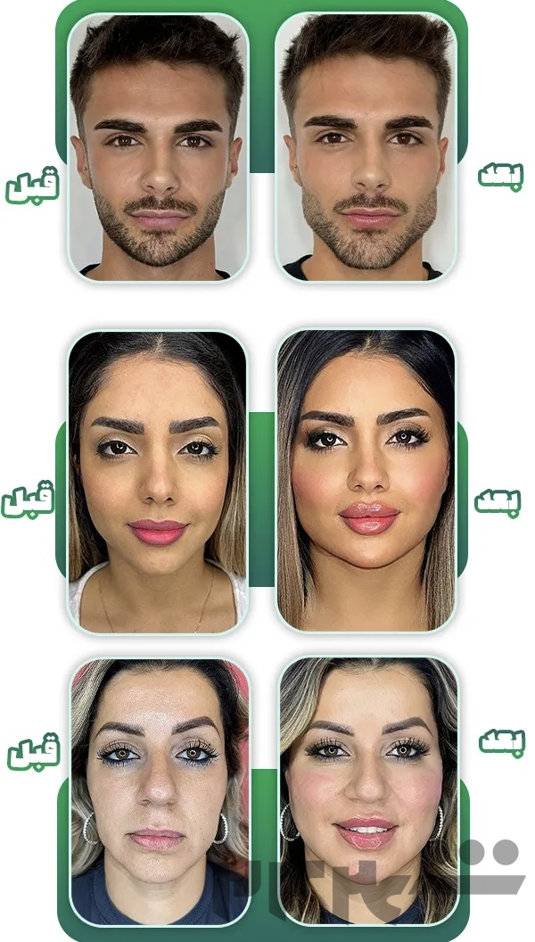 تخفیف ویژه تزریق فیلر لیبل دار با ماندگاری بالا