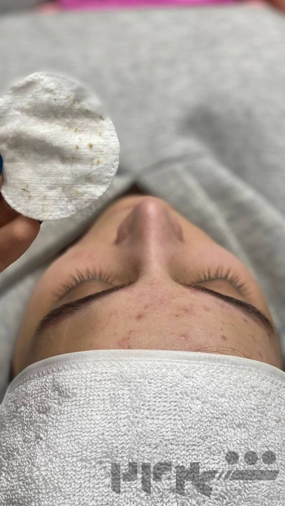 فیشال درمانی + درمان تخصصی جوش‌های کمر و باسن