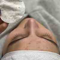 فیشال درمانی + درمان تخصصی جوش‌های کمر و باسن