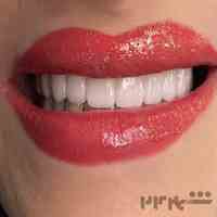 ایمپلنت با اقساط ویژه