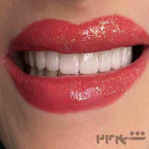 ایمپلنت با اقساط ویژه