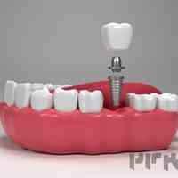 ایمپلنت دندان در اندیشه 