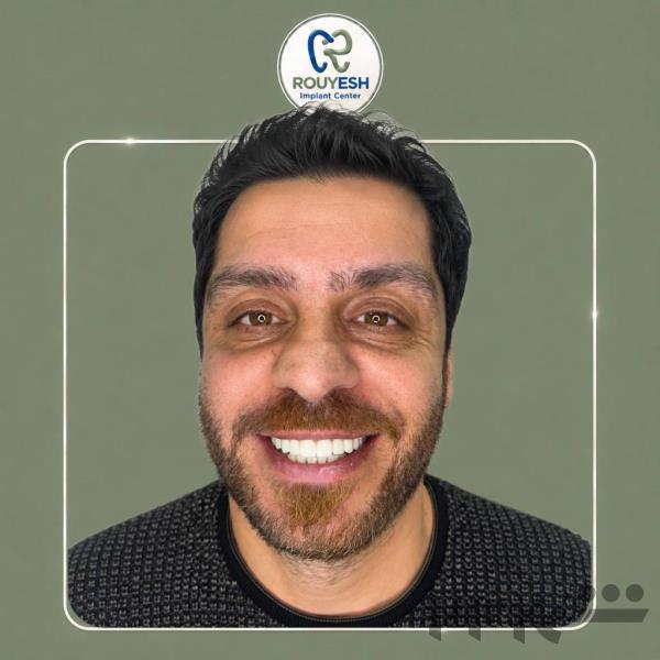 ایمپلنت دندان با روکش و اقساط بلندمدت | دندانپزشکی رویش مرزداران 