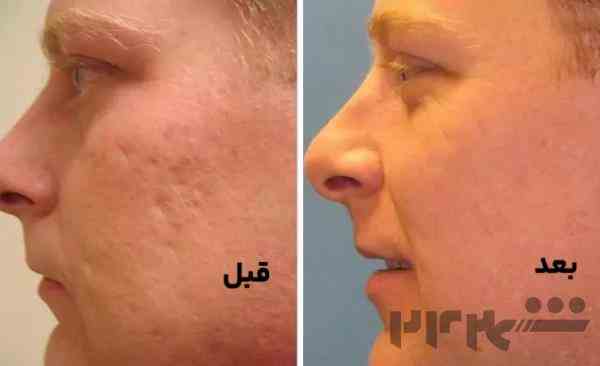 کربوکسی تراپی در تهران
