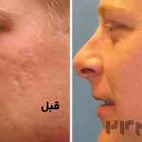 کربوکسی تراپی در تهران