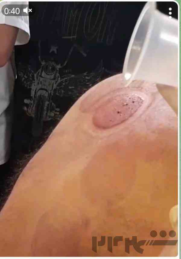 کار علمی حجامت