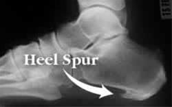  درمان خارپاشنه (Heel Spur) کلینیک تخصصی پا